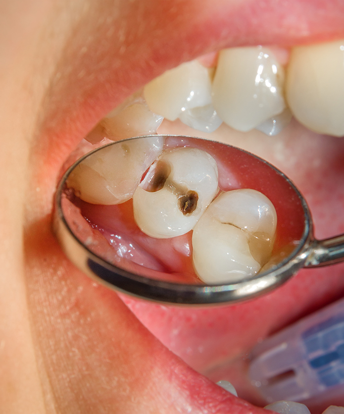 Que faire si une carie fait son apparition ?