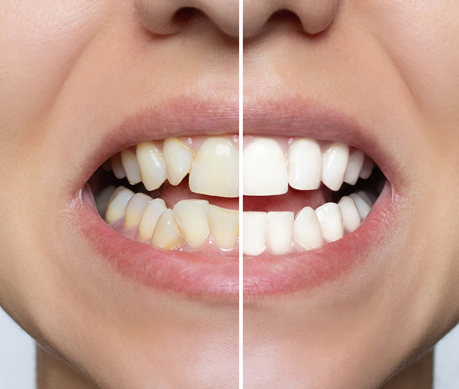 Ce que vous devez savoir sur la couleur des dents