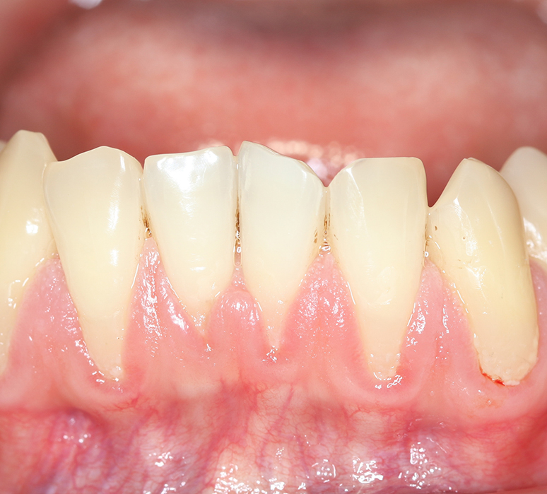 Ce qu’est la récession gingivale