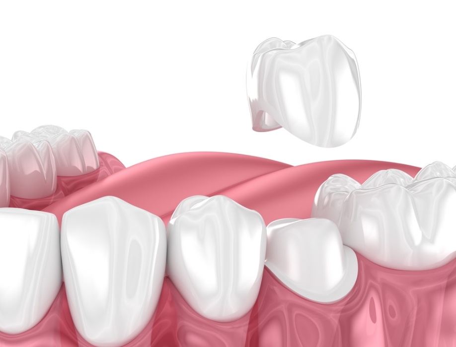 Couronne dentaire Couronne dentaire