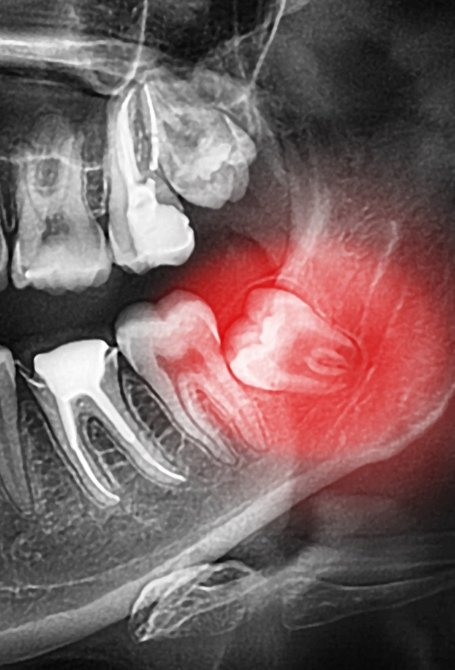 Extraction Dentaire Edmunston Extraction Dentaire Edmunston