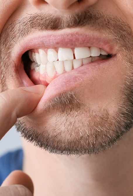 Greffe de gencive Greffe de gencive