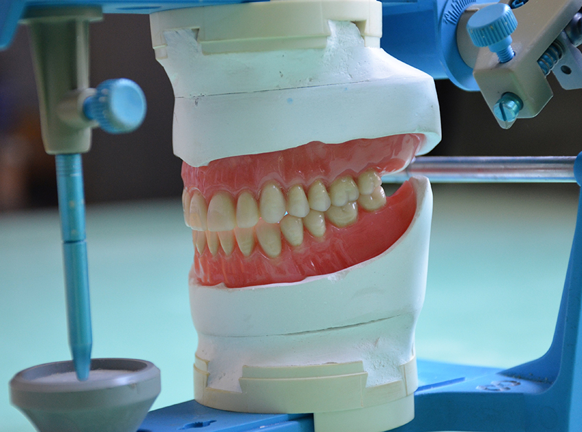 La prothèse amovible complète