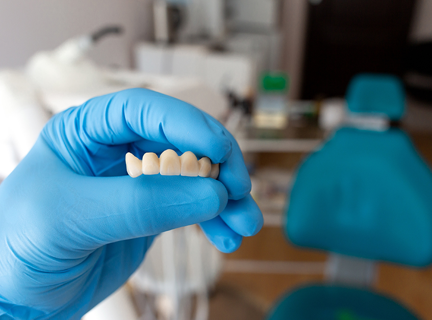 Le pont dentaire Le pont dentaire