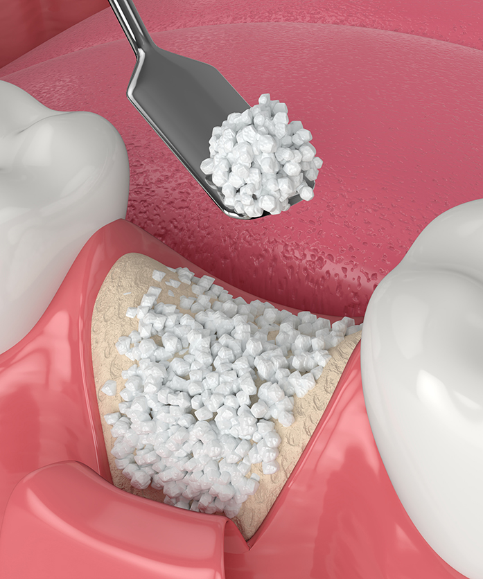 Les différents types de greffes