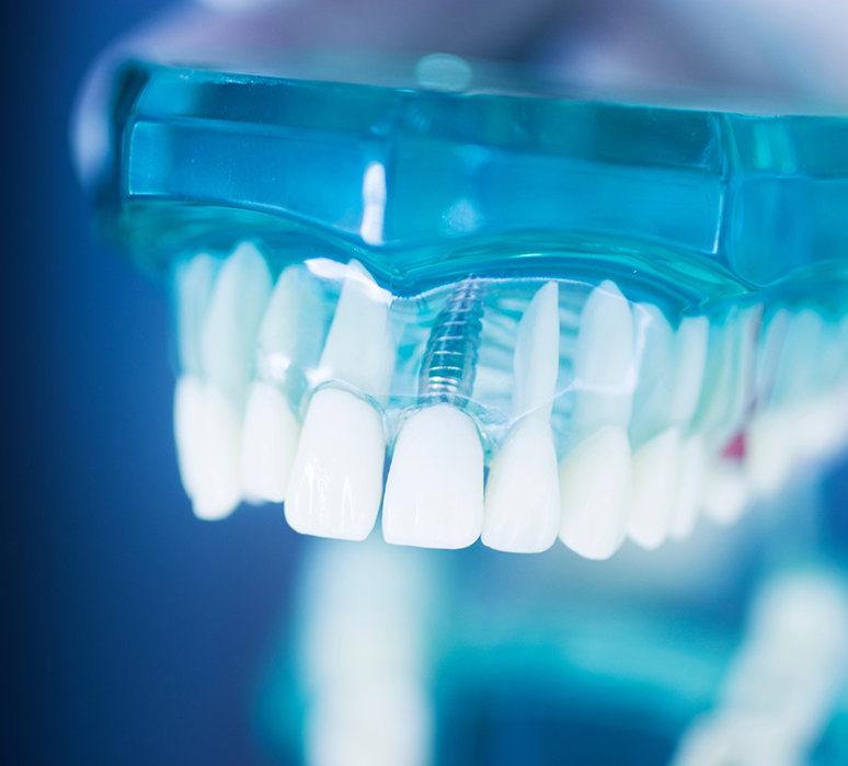 Pourquoi les implants dentaires sont-ils une bonne option de substitution ?