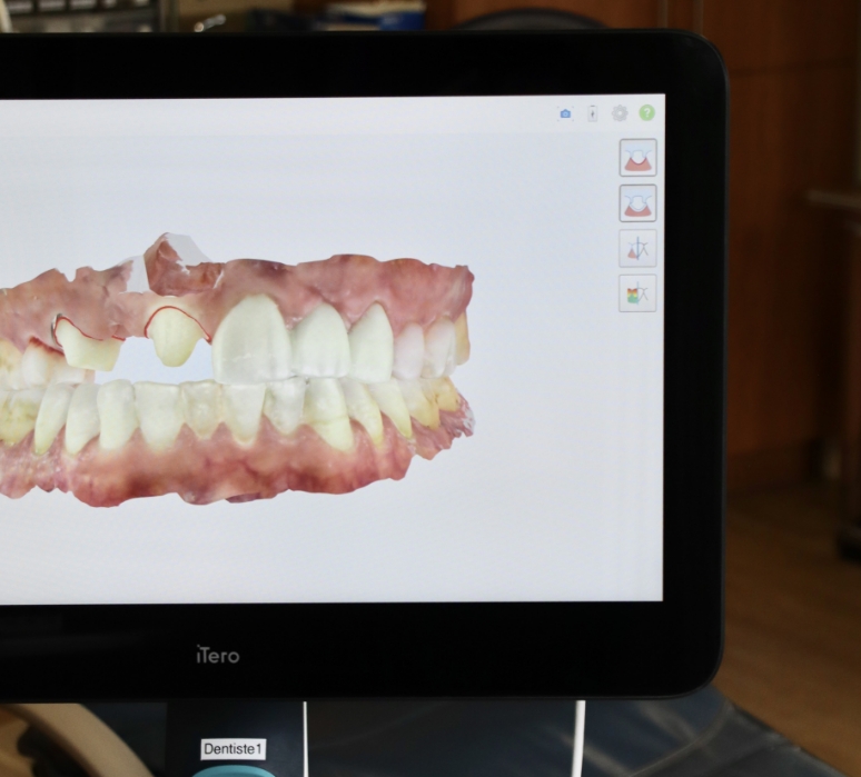 Scanneur dentaire 5D (iTero) Scanneur dentaire 5D (iTero)