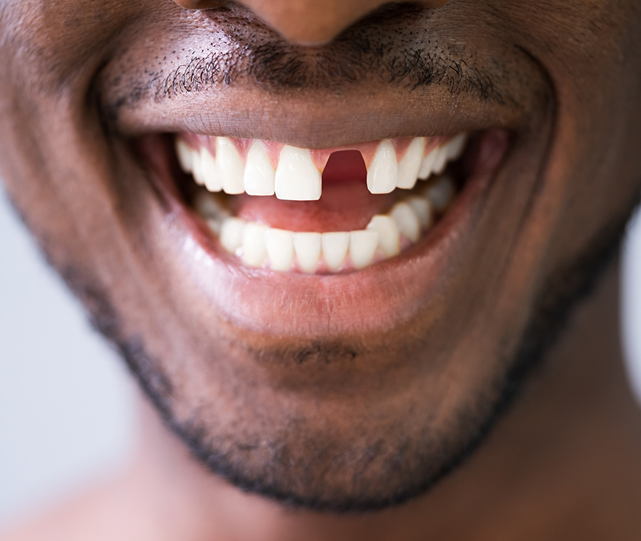 Situations menant à une greffe osseuse