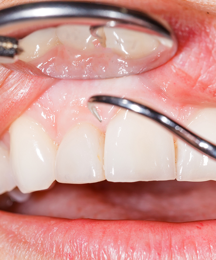 Traitements des maladies parodontales