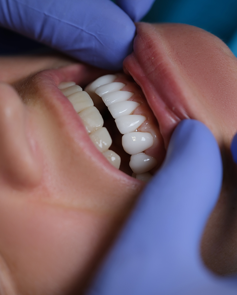 Est-ce que tout le monde peut avoir recours aux facettes dentaires ? Est-ce que tout le monde peut avoir recours aux facettes dentaires ?