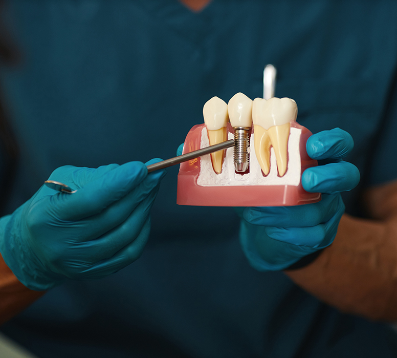 Qu’est-ce qu’un implant dentaire ?